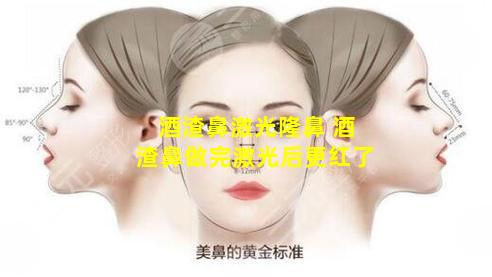 酒渣鼻激光隆鼻 酒渣鼻做完激光后更红了